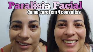 PARALISIA FACIAL CURA EM 4 SESSÕES  DR ROMULO PIMENTA [upl. by Adnalu]