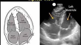 How to Cardiac Ultrasound  Apical View Case Study [upl. by Kora]