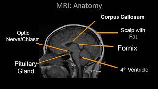 Normal Head CT Scan Anatomy Made Simple Neuroradiology [upl. by Barbette531]