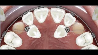 Orthodontic case report for palatally impacted canines traction [upl. by Rolyat]