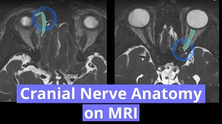 Cerebral Vascular Anatomy And Imaging [upl. by Nauqyt]