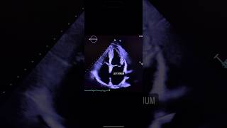 Apical 4 Chamber View echocardiography cardiology echocardiogram [upl. by Ahsieki]