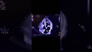 Apical 5 Chamber View echocardiography cardiology echocardiogram [upl. by Trembly]