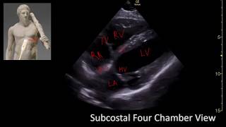 Subcostal Four chamber View Perioperative amp Critical Care ECHO POCUS [upl. by Liebermann]