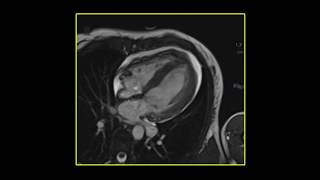 Coronavirus Myocarditis Magnetic Resonance Imaging 4Chamber View [upl. by Stead366]