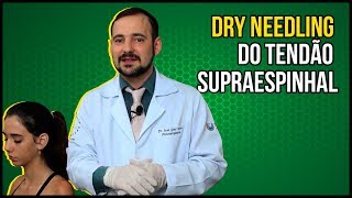 Dry Needling do Tendão Supraespinhal  VEJA EM TEMPO REAL [upl. by Anyehs491]