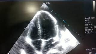 CARDIAC TAMPONADE ECHO APICAL FOUR CHAMBER VIEW [upl. by Anzovin117]