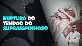 Ruptura do tendão do supraespinhoso [upl. by Yesdnil]