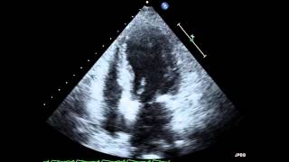 Takotsubo Cardiomyopathy Echocardiogram [upl. by Anikehs]