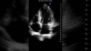 Cardiac Apical 4 Chamber Butterfly iQ Clinical Image [upl. by Yenattirb]