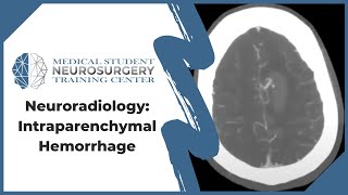 Neuroradiology Intraparenchymal Hemorrhage [upl. by Potter]